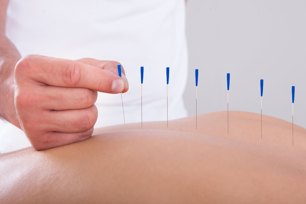 Acupuncture Needles into a persons back