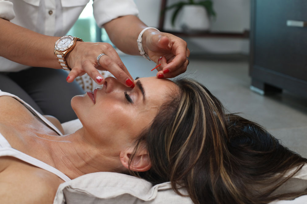 Women receiving acupuncture treatment for a migraine