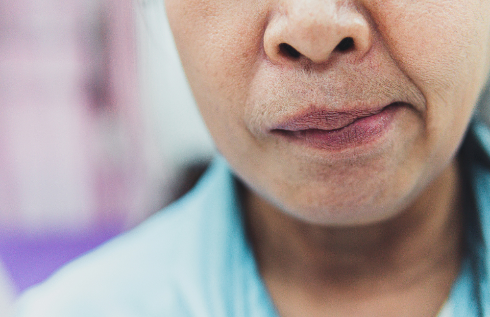 Is acupuncture for bells palsy helpful?